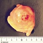 Progestagenically active cyst