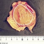 Progestagenically active cyst