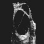 Progestagenically active (section) cyst (usg)